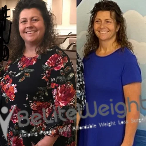 Weight Loss Surgery Before And After